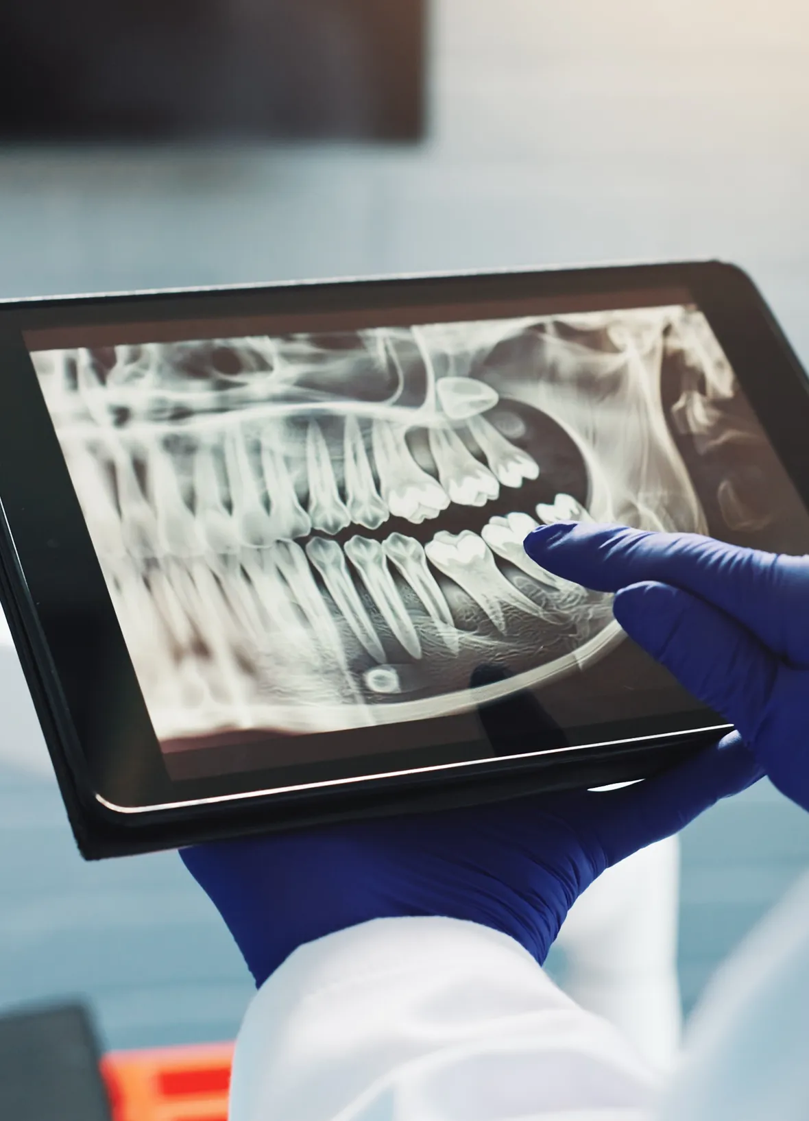 Dental Extractions