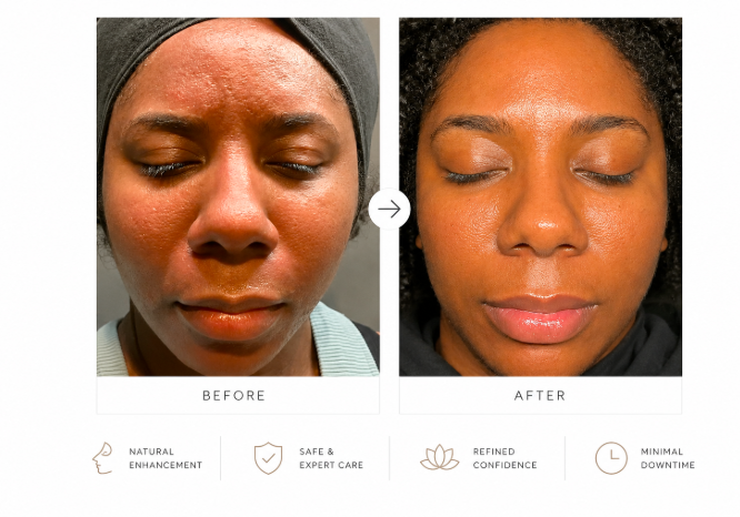 results 4 facial e1784141860912