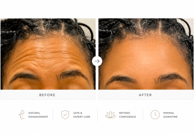 results 2 forehead e1784141456950